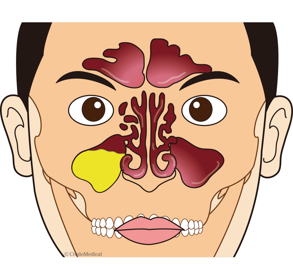 副鼻腔炎(ちくのう)の注意点、治療について。早期発見し完治させることが大切! | 尾道市向島町の小坂耳鼻咽喉科クリニック